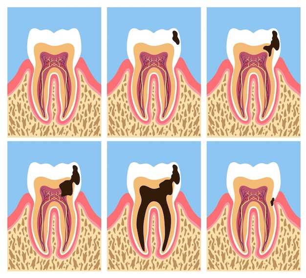 2. Poor oral hygiene: